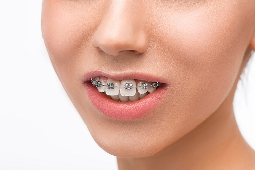 metal braces cost 